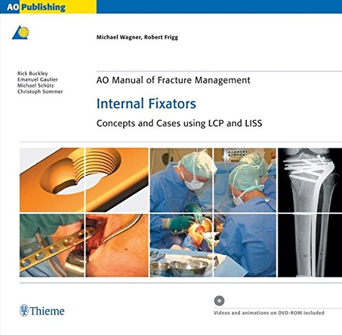 ao-manual-of-fracture-management-internal-fixators