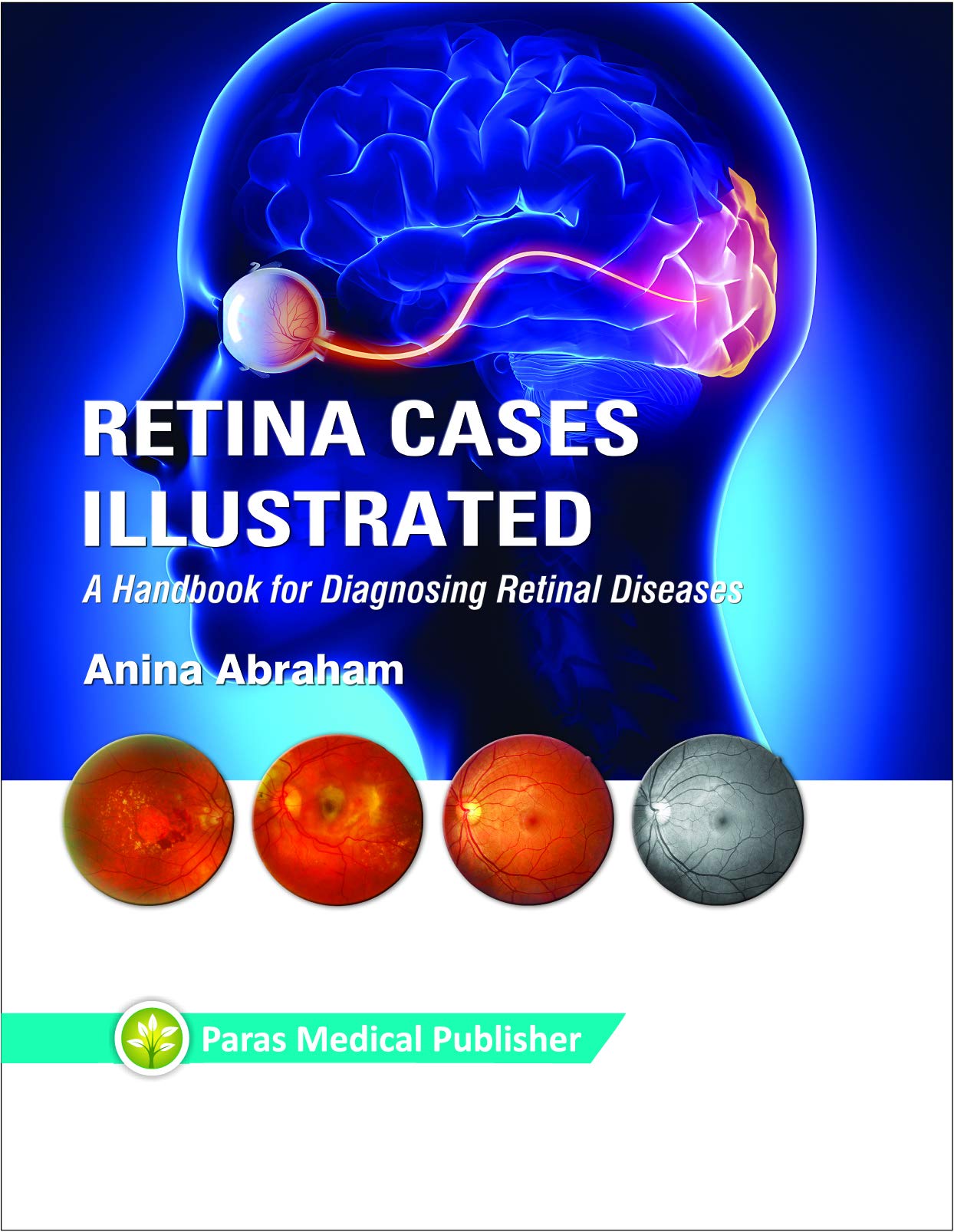 retina-cases-illustrated