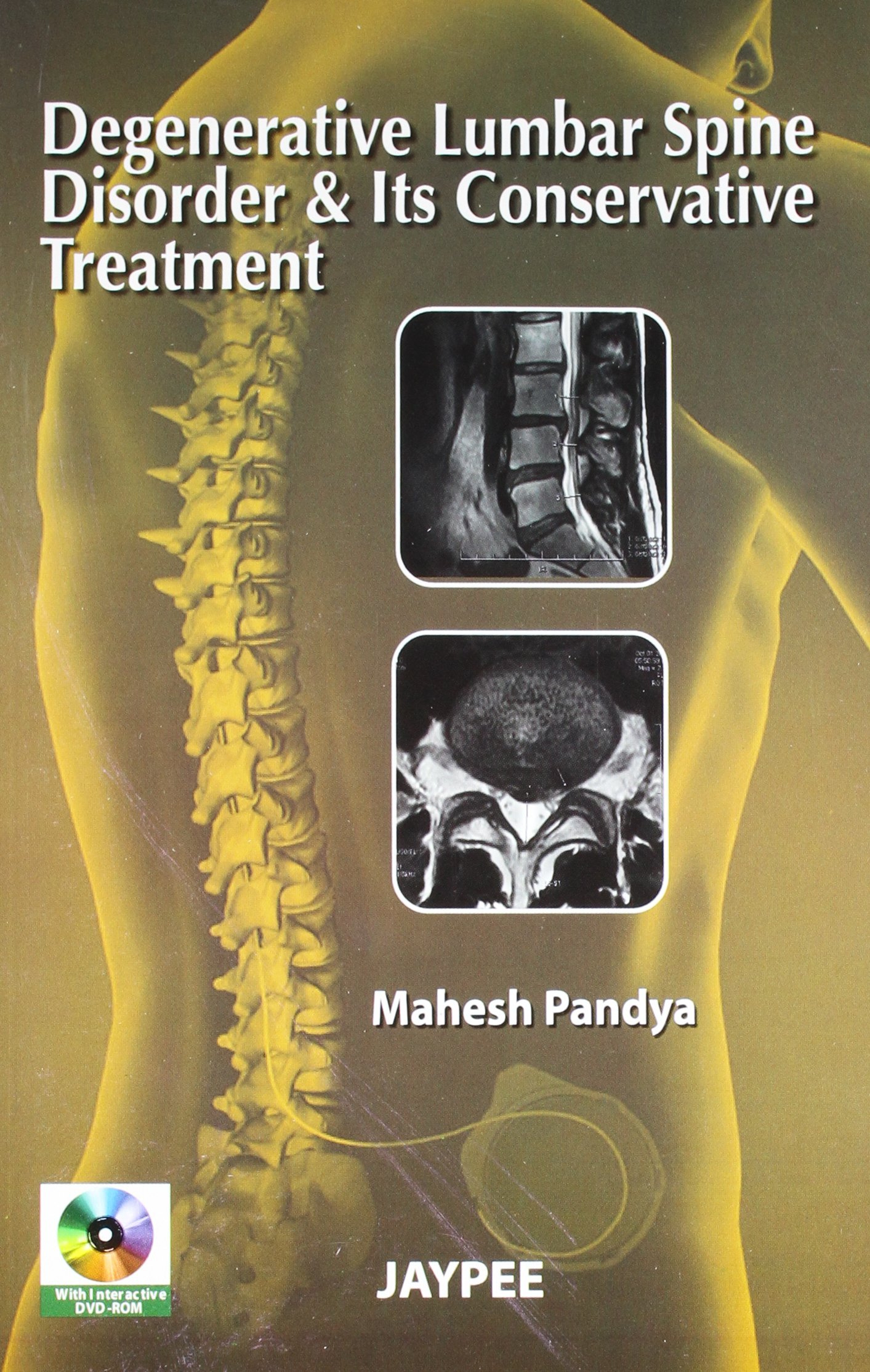 degenerative-lumbar-spine-disorder-its-conservative-treatment-with-dvd-rom