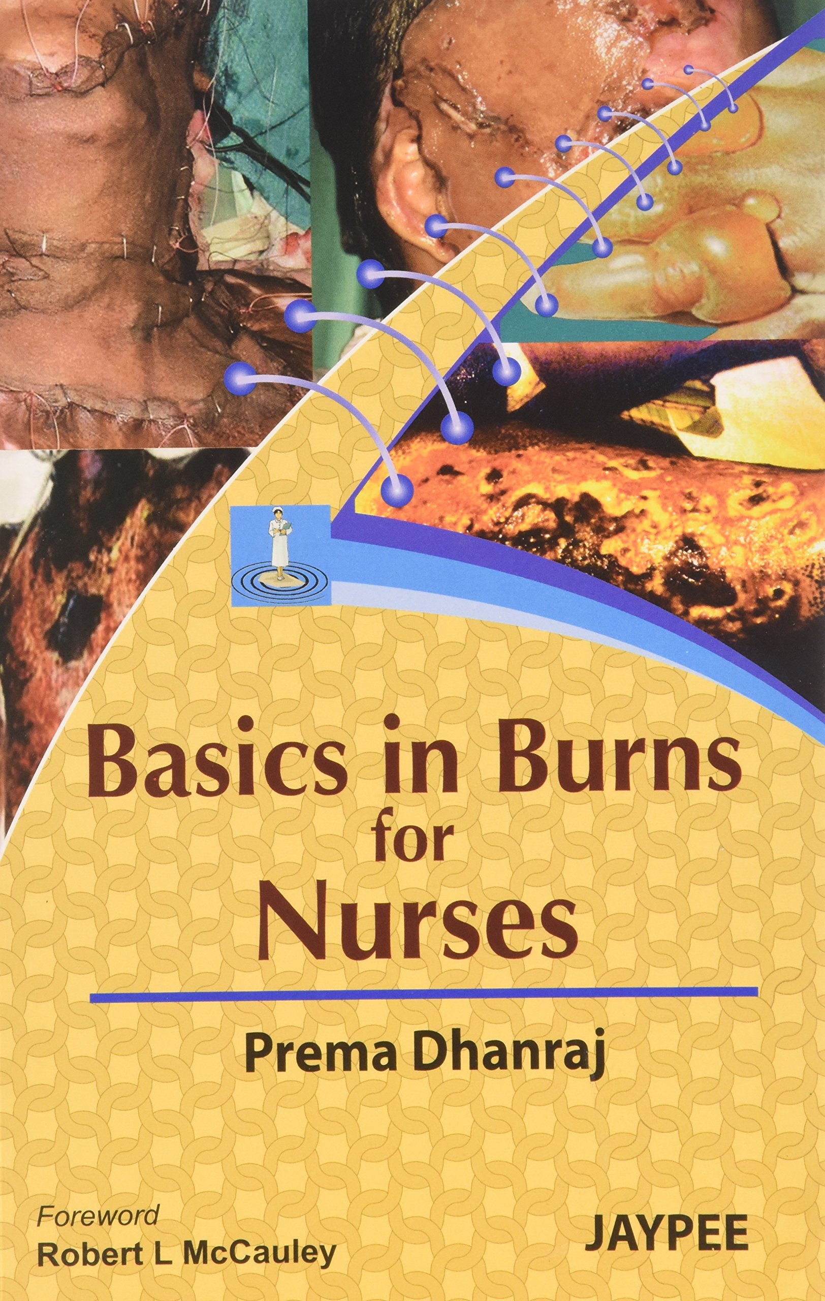 basics-in-burns-for-nurses
