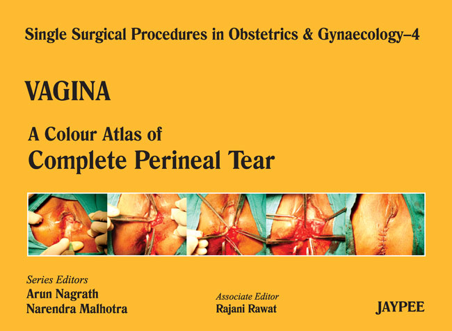 vagina-4acaof-complete-perineal-tear-sspog