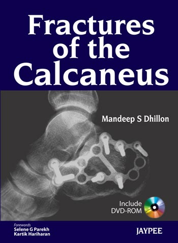 fractures-of-the-calcaneus-with-dvd-rom