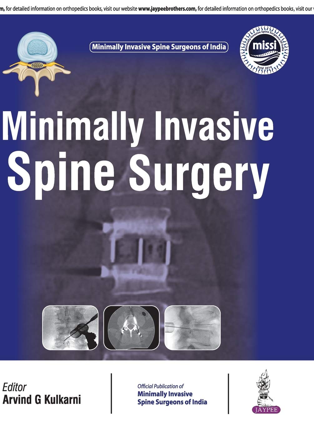 minimally-invasive-spine-surgeryofficial-publication-of-minimally-invasive-spine-surgeons-of-india