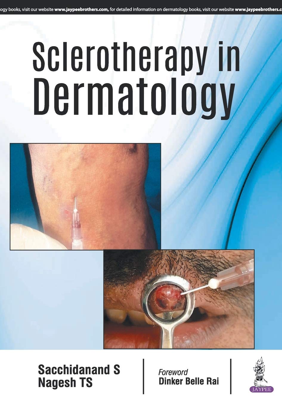 sclerotherapy-in-dermatology