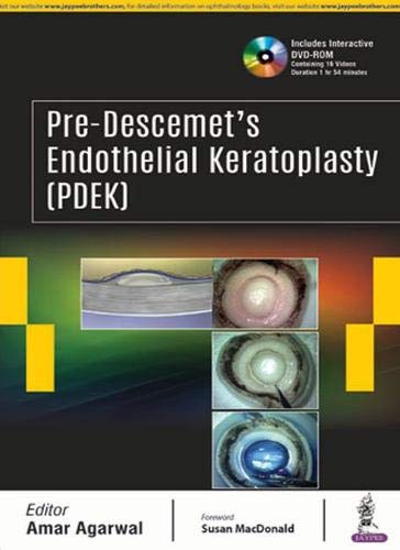 pre-descemets-endothelial-keratoplastypdek