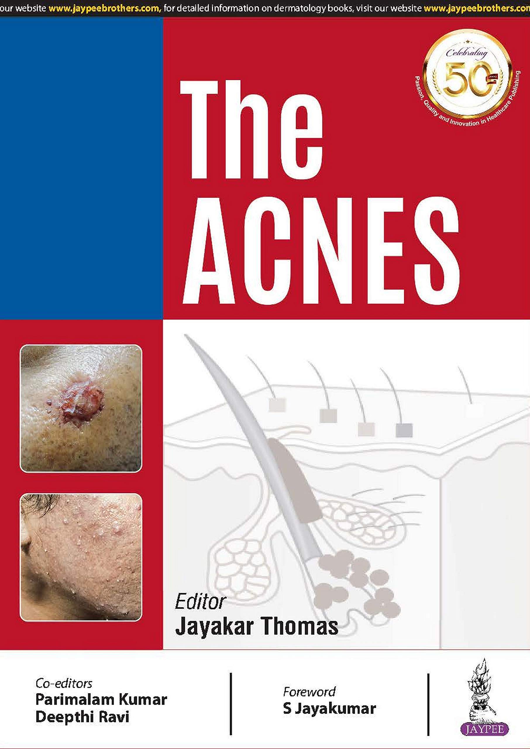 the-acnes