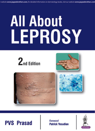 all-about-leprosy