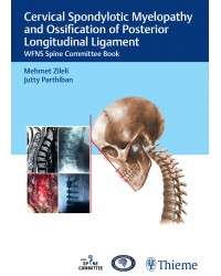 cervical-spondylotic-myelopathy-and-ossification-of-posterior-longitudinal-ligament-wfns-spine-committee-book