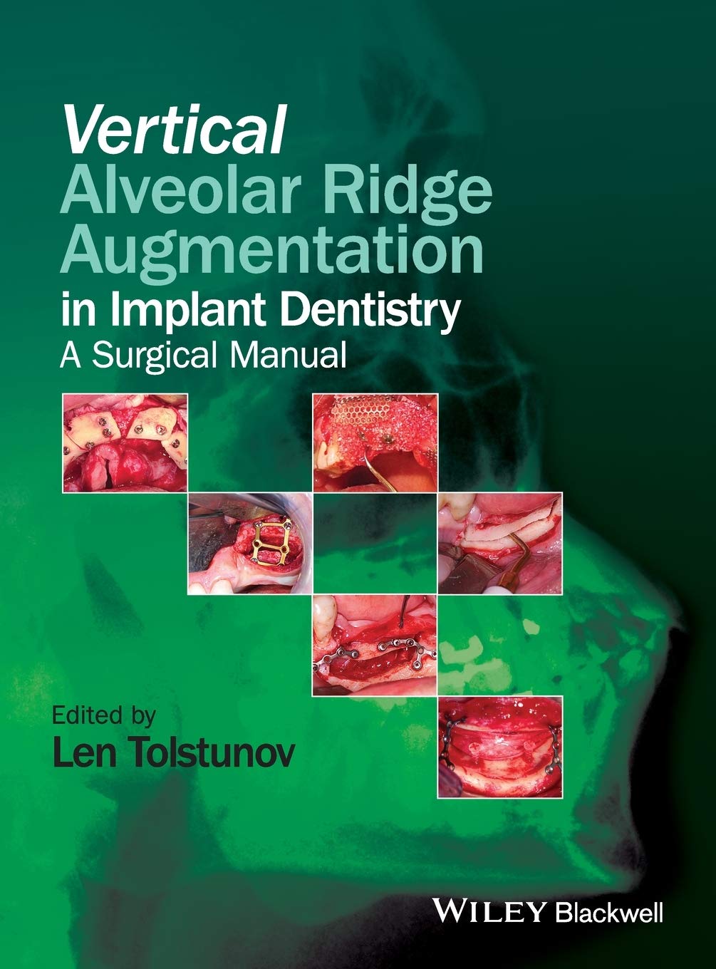 vertical-alveolar-ridge-augmentation-of-the-alveolar-ridge-in-implant-dentistry