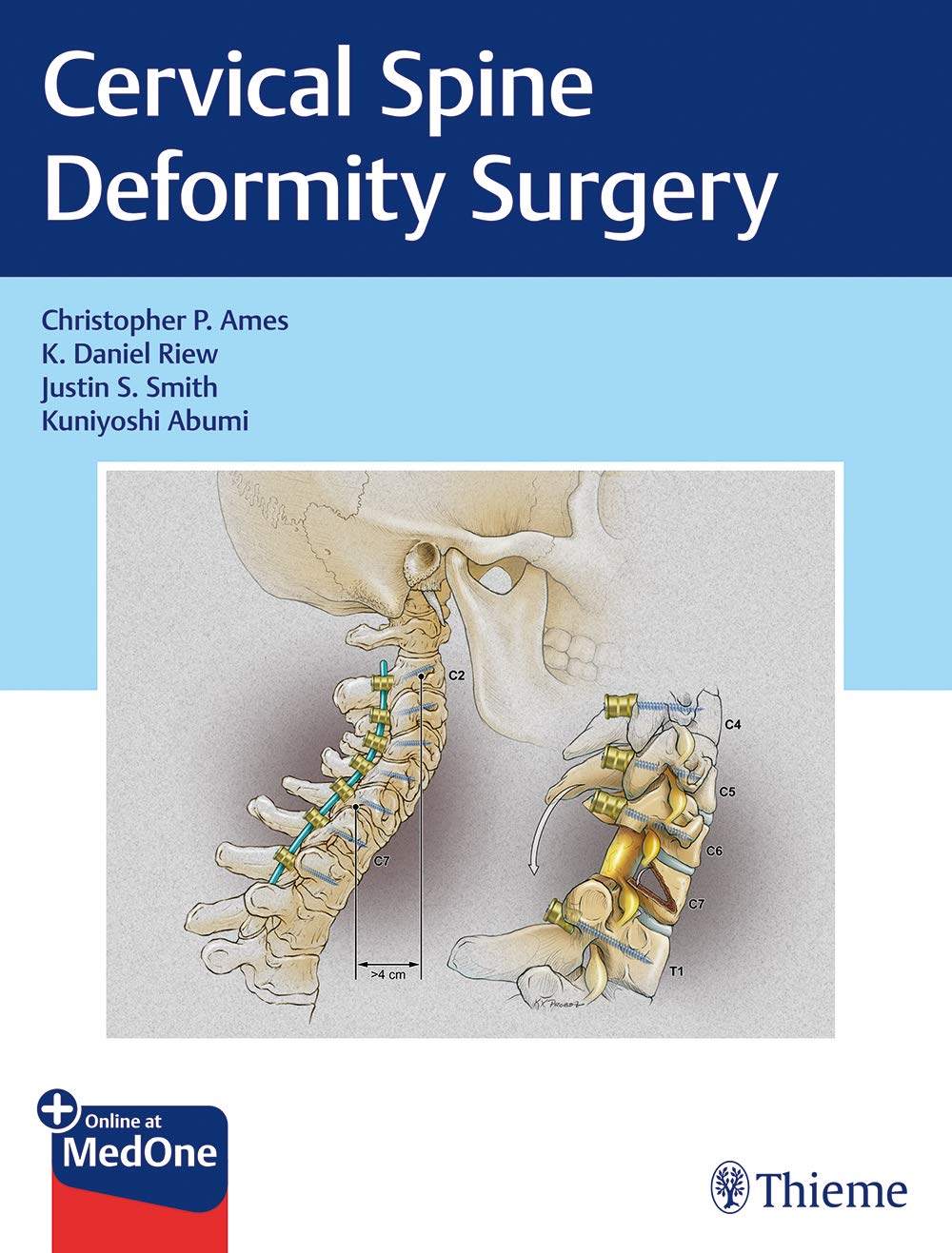 cervical-spine-deformity-surgery-1e