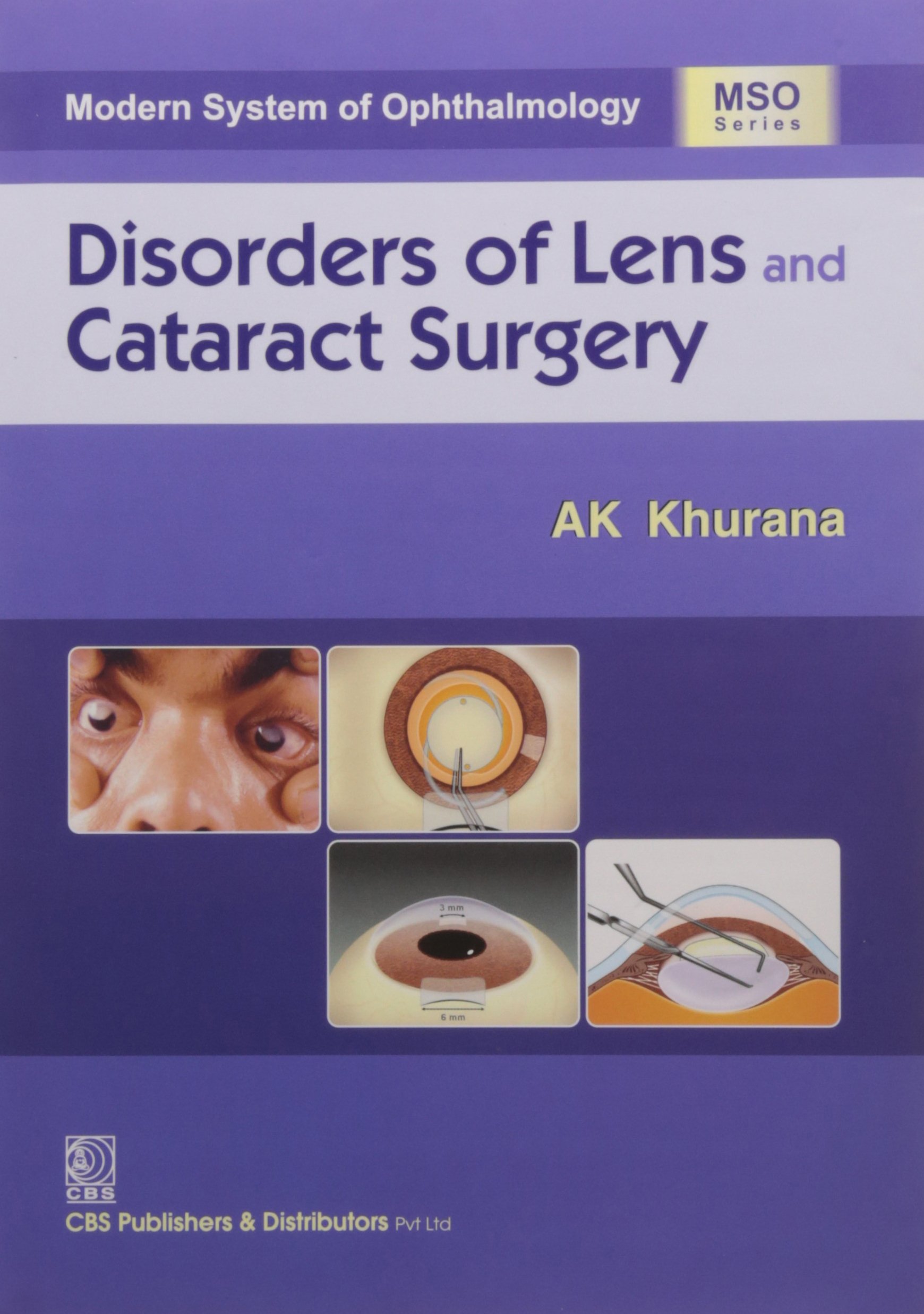 modern-system-of-ophthalmology-disorders-of-lens-cataract-surgery-hb