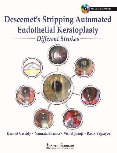 descemets-stripping-automated-endothelial-keratoplastydifferent-strokes
