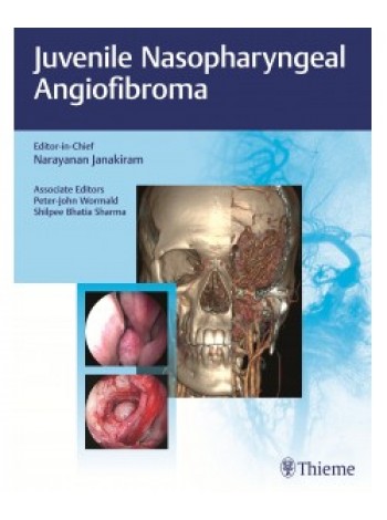 juvenile-nasopharyngeal-angiofibroma-1e