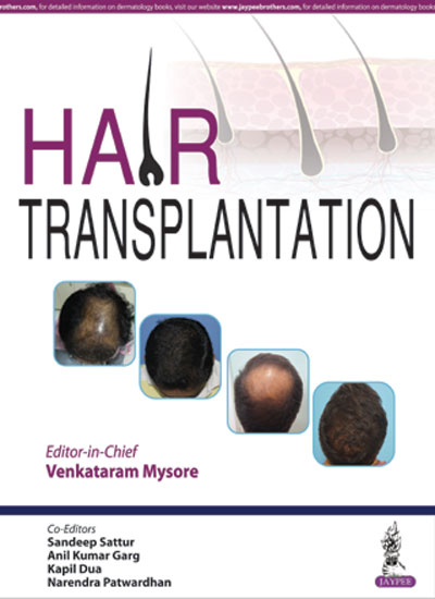 hair-transplantation